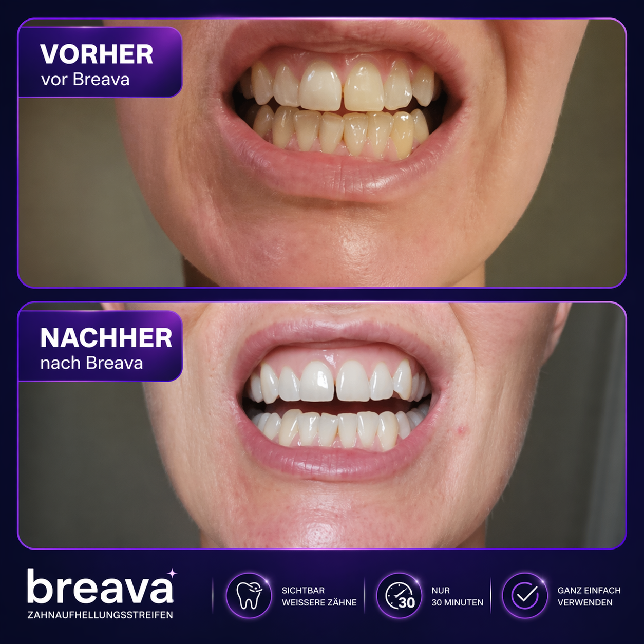 Breava™ | Whitening Strips
