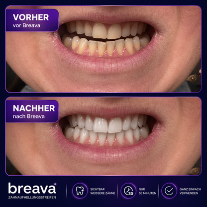 Breava™ | Whitening Strips