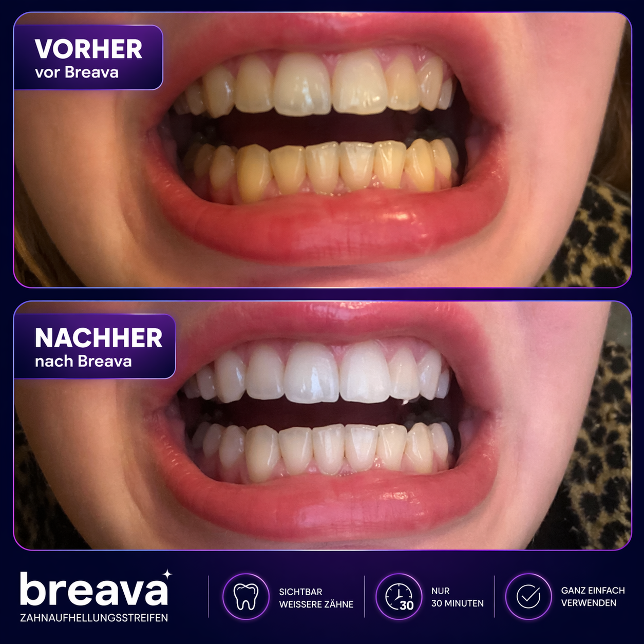 Breava™ | Whitening Strips